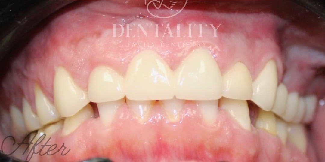 After treatment
