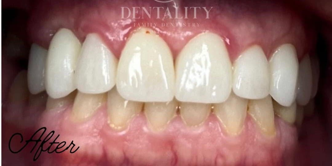 After treatment